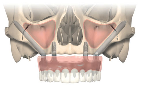 Zygoma implantaten Dr Oliver Oth Spécialités